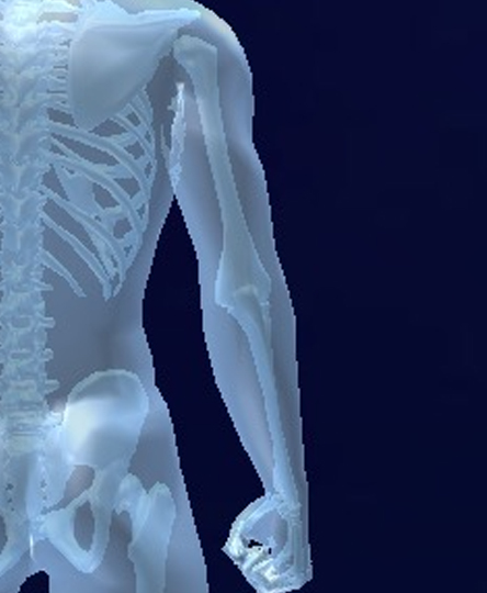 Upper Limb - Cascade Orthotics Calgary
